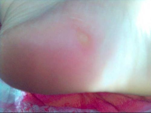 bouton sous le pied qui fait mal bouton sous le pied qui fait mal